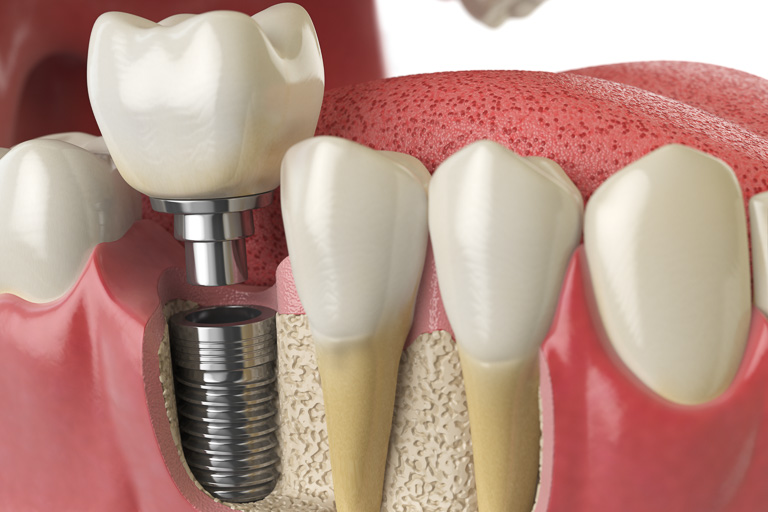 Anatomy of healthy teeth and tooth dental implant in human denturra.